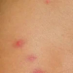 Oh No! Bed Bugs Bites at Home in Bangalore? Here’s What to Do!