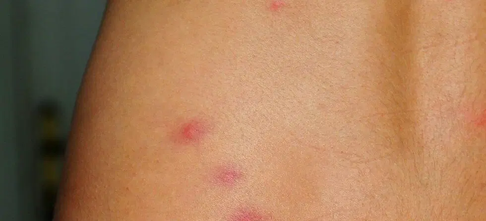 bed bugs bites